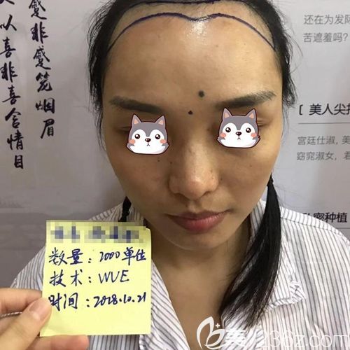 術(shù)前進(jìn)行劃線美學(xué)設(shè)計(jì) 術(shù)前進(jìn)行劃線美學(xué)設(shè)計(jì)