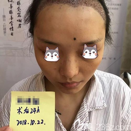 利用了WUE四維無(wú)痕種植技術(shù) 利用了WUE四維無(wú)痕種植技術(shù)