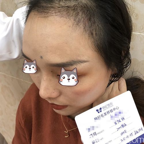 利用WUE無(wú)痕植發(fā)技術(shù)在前額種植2000單位是我成功告別大額頭的秘訣