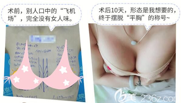 看過對比照+真人反饋，我決定了就在他家做德美茜茜假體豐胸