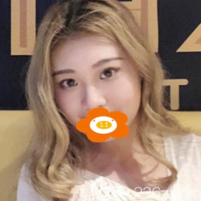 做面部吸脂手術(shù)前的我 做面部吸脂手術(shù)前的我