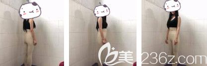 大腿吸脂術(shù)后一周穿塑腿褲 大腿吸脂術(shù)后一周穿塑腿褲