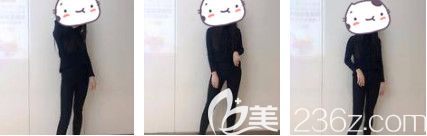 大腿吸脂術(shù)后20天消腫 大腿吸脂術(shù)后20天消腫