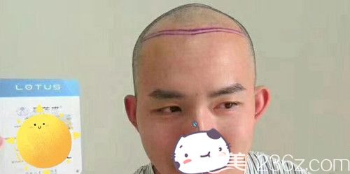 醫(yī)生設計了種植區(qū)域