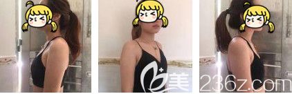 術(shù)前是平胸 術(shù)前是平胸