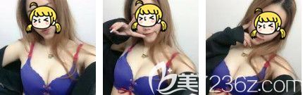 法國(guó)ES磨砂面假體豐胸手術(shù)讓我的胸部Cup升級(jí)兩個(gè)罩杯