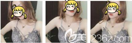 假體隆胸術(shù)后15天胸部消腫 假體隆胸術(shù)后15天胸部消腫