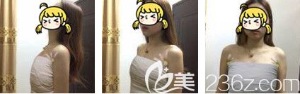 剛做完假體隆胸手術(shù)后胸部微腫 剛做完假體隆胸手術(shù)后胸部微腫