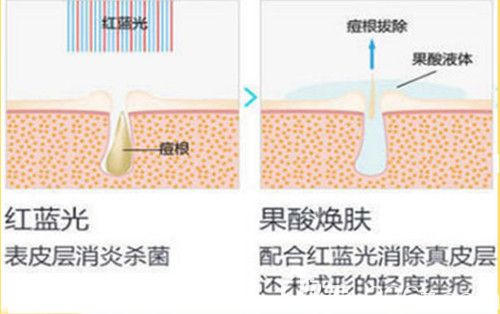 張素芬醫(yī)生激光祛痘過(guò)程 張素芬醫(yī)生激光祛痘過(guò)程