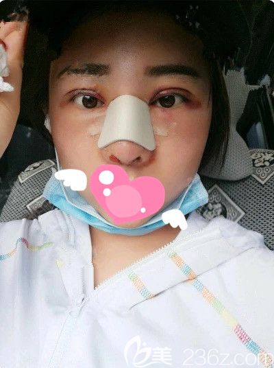 剛做完膨體隆鼻+雙眼皮+開內(nèi)眼角