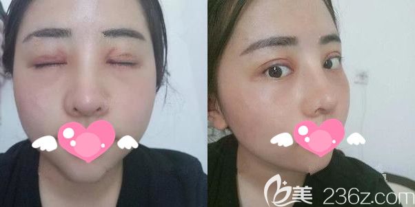 術(shù)后一周拆線膨體隆鼻+雙眼皮+開內(nèi)眼角恢復(fù)