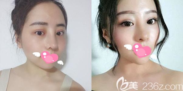 膨體隆鼻+雙眼皮+開內(nèi)眼角半月恢復(fù)