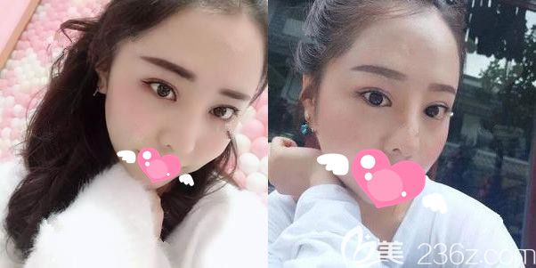 眼鼻綜合恢復(fù)期太丑了，但是半月后就開始慶幸自己同時做了膨體隆鼻+雙眼皮開眼角