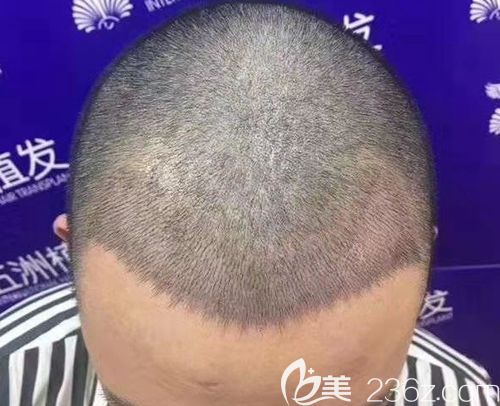 雖然我額頭發(fā)際線光禿部位的毛囊已經(jīng)閉合，但是植發(fā)讓它“發(fā)芽復(fù)活”!