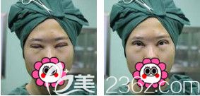 剛做完眼綜合術(shù)后眼睛紅腫