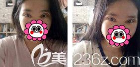 眼綜合術(shù)后3天眼睛微腫