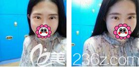 做完眼綜合手術(shù)1個(gè)月雙眼皮線條流暢