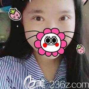 后悔自己沒早做全切雙眼皮+開內(nèi)眼角+上瞼提肌手術(shù) 白白丑了28年