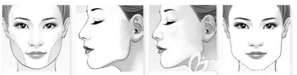 下頜骨寬大的臉型