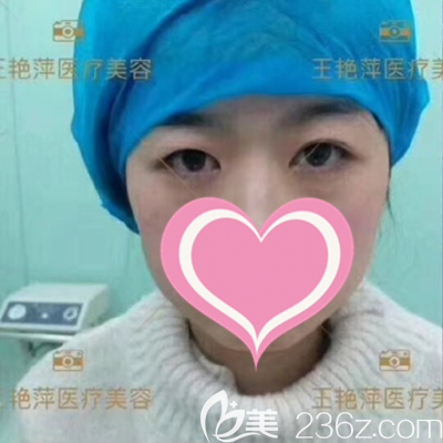 做雙眼皮手術(shù)前 做雙眼皮手術(shù)前