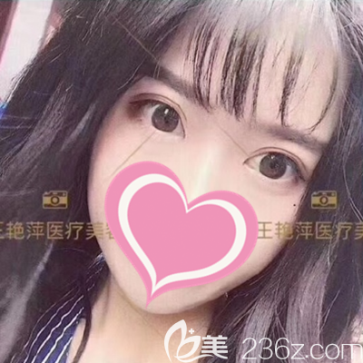 做完雙眼皮手術(shù)15天 做完雙眼皮手術(shù)15天