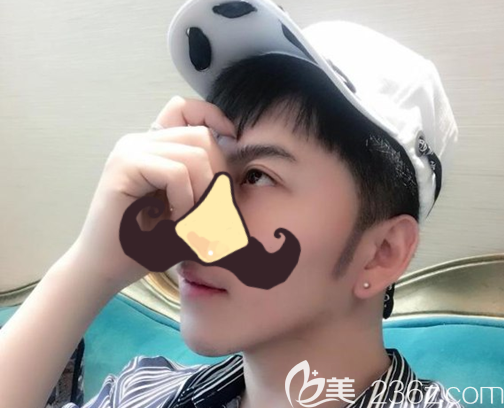 鬢角種植500毛囊7天后效果，跟發(fā)際線銜接自然“超原生態(tài)”