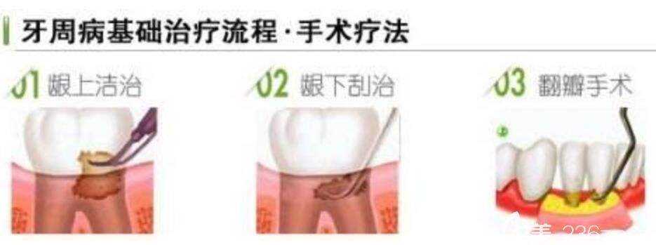 牙周炎的治療方式