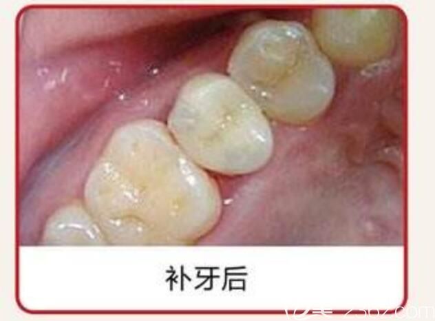 補(bǔ)牙圖片