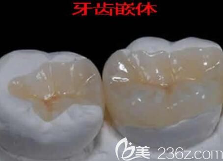 牙齒嵌體