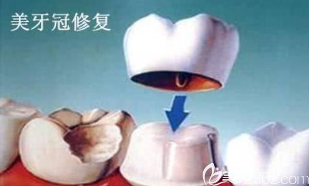 牙冠修復(fù)