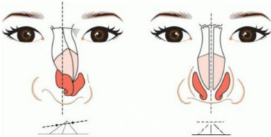 影響隆鼻價格的因素