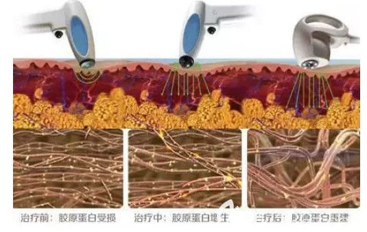 張楊醫(yī)生做射頻緊膚原理