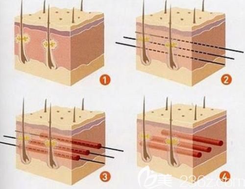 程蘭娣醫(yī)生做埋線提升手術(shù)過程 程蘭娣醫(yī)生做埋線提升手術(shù)過程