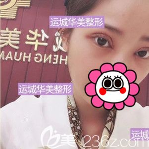 開眼角+微創(chuàng)雙眼皮術(shù)后即刻