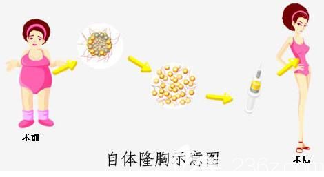 自體脂肪豐胸的原理 自體脂肪豐胸的原理