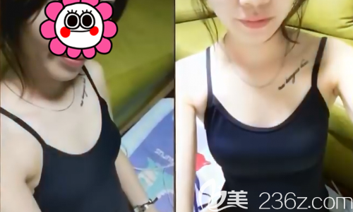 隆胸術(shù)前A罩杯面診 隆胸術(shù)前A罩杯面診