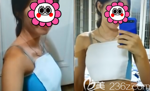 初次脂肪填充胸部后效果 初次脂肪填充胸部后效果