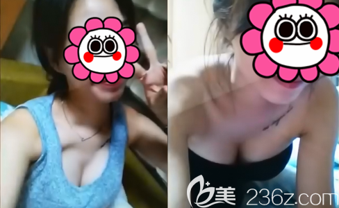 術(shù)后兩個(gè)月做了二次脂肪填充后的效果 術(shù)后兩個(gè)月做了二次脂肪填充后的效果