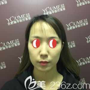 22歲面部皮膚出現(xiàn)了松弛下垂 22歲面部皮膚出現(xiàn)了松弛下垂