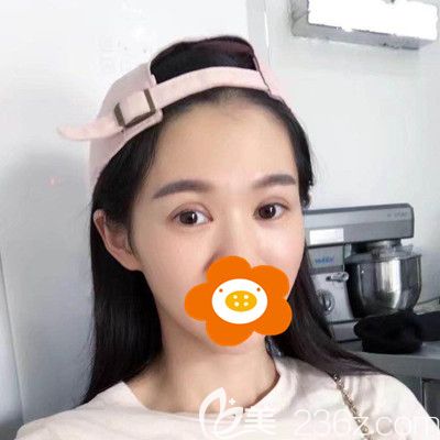 術(shù)后一周眼睛還是有點腫 術(shù)后一周眼睛還是有點腫