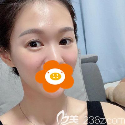 雙眼皮失敗修復(fù)已經(jīng)3個(gè)月了！一起來(lái)感受下被我喜歡的眼睛吧！