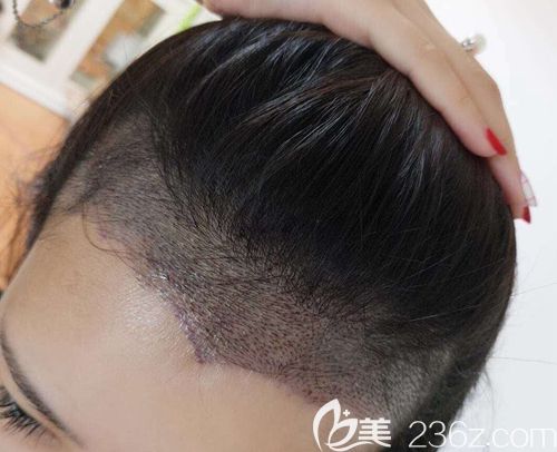 在腦門發(fā)際線處種植了2500單位 在腦門發(fā)際線處種植了2500單位