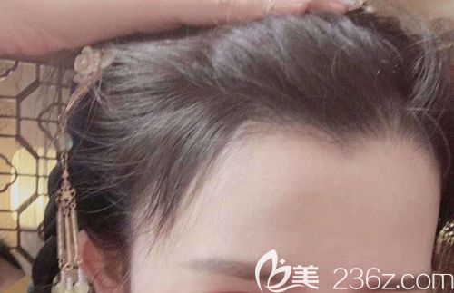我額頭發(fā)際線高達(dá)五指寬!醫(yī)生給我設(shè)計(jì)了美人尖發(fā)際線調(diào)整方案