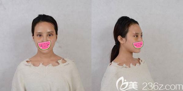 做完雙眼皮修復(fù)術(shù)后三天腫脹樣子 做完雙眼皮修復(fù)術(shù)后三天腫脹樣子