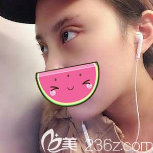 一周后拆線眼部恢復(fù) 一周后拆線眼部恢復(fù)