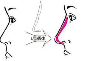 價格便宜隆鼻手術謹慎選擇