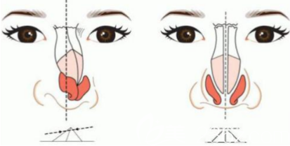 假體隆鼻容易出現(xiàn)的后遺癥