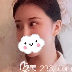 豐太陽穴術(shù)后8天有點(diǎn)小腫脹