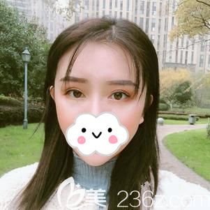 填充太陽穴術(shù)后25天護(hù)理到位吸收穩(wěn)定