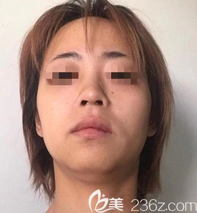 磨骨手術(shù)前 磨骨手術(shù)前